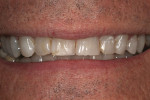 Figure 1 Preoperatively, the patient was unhappy with the worn incisal edges of his anterior teeth.
