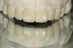 Figure 3 A full-contour Kaleidoscope Treatment Plan Wax -Up™ (LSK121 Oral Prosthetics, www.lsk121.com) was used.