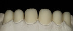 Figure 6 Aadva zirconia copings were milled at the GC Milling Center.