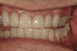 Figure 11 Protrusion view showing the restorations in the mouth.