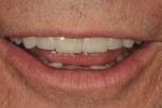 Figure 13 Relaxed view of the patient with the final restorations.