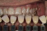 Figure 2 Custom-made shade tabs were used to provide a color match with the patient’s dentition.