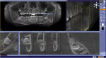 Figure 6 The ideal CBCT software is intuitive, easy to use, and includes a standard panoramic reconstruction for orientation and navigation.