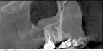Figure 4 The source of this patient’s pain (in Figure 3) is immediately obvious in a CBCT image.