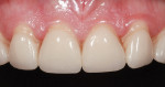Figure 2 Preoperative frontal view of anterior tooth No. 1.