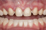Figure 5 Facial view of the intraoral preparations. The worn anterior veneers were removed and the natural dentition was displayed.