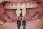 Figure 4 In the dental office, a shade tab record was taken to match the new veneers against the surrounding natural dentition.