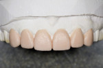 Figure 3 A diagnostic wax-up was fabricated in the dental office depicting the anticipated height-to-width ratio of the new porcelain veneers.