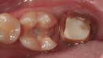 Figure 1 Initial appearance of the teeth when the patient presented for treatment.