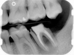 Figure 2 Initial radiographs showing the fractured mesial root.