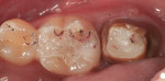 Figure 5 Provisional restoration in place, after checking for ideal occlusal contacts and interproximal contact.