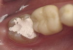 Figure 1 Preoperative photograph of tooth No. 31 with temporary restoration after endodontic treatment.
