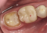 Figure 2 Tooth No. 31 with the final core build-up.