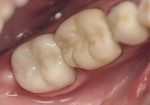 Figure 3 Final e.max restoration of tooth No. 31 bonded using MultilinkEZ.