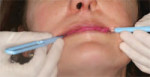 Figure 3 This patient has had anterior crown preparations; the assistant is holding the occlusal registration strips on the non-prepared posterior teeth on each side.