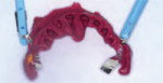 Figure 4 The hardened polyvinylsiloxane material is removed after 3 minutes. Note the presence of the occlusal registration strips incorporated into the bite registration material.The strips can either be removed or remain during the mounting of the model