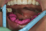 Figure 8 The assistant has preplanned exactly where the occlusal registration strips will be placed.