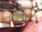 Figure 3 The old restorations and caries were removed, with care taken to conserve as much tooth structure as possible.