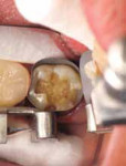 Figure 7 A matrix band was placed around the tooth.