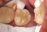 Figure 9 The second and final increment of restorative composite (Venus Diamond) was placed and cured.
