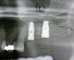 Figure  4  Postoperative panoramic radiographs of implants placed into maxillary alveolar ridge bilaterally (Surgical Stage 1).