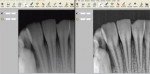 Figure 3 The radiograph on the right has been modified from the image on the left by applying the 