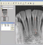 Figure 4 The multiple line measurement tool was used to determine the approximate length of the curved canal shown in this modified radiograph.