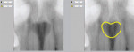 Figure 5 The radiograph on the left depicts a heart-shaped inter-radicular midline radiolucency between the roots of maxillary incisor teeth that is virtually pathognomonic for a nasopalatine duct cyst (NPDC). The image on the right highlights the lesion 