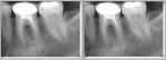 Figure 6 On the left is a radiograph of an incomplete endodontic procedure with periradicular pathosis. On the right is the same image with an 