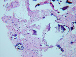 Figure  6  Histological evaluation at UCSF laboratory 3 months after GBR: Bio-Oss shows sclerotic bone with foreign material, partial bone integration, and moderate degree of vascularization.