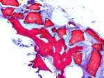 Figure  7   Histological evaluation of undecalcified (mineralized) Bio-Oss 3 months after the GBR at Progentix laboratory shows poor integration of the grafting material into surrounding bone.