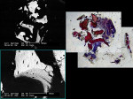 Figure  8  BSEM and histological evaluation (light microscopy) of Bio-Oss 9 months after grafting and 6 months after implant insertion at Progentix laboratory show the coexistence of newly formed bone and Bio-Oss granules, surrounded by fibrous tissu