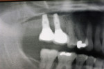 Figure  12   Final panoramic close-up radiographs 3 months after delivery of two bilateral, implant-supported bridge prostheses. A stable alveolar bony foundation can be seen around the implant fixtures, which is adequate to support implant-based res