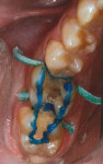 Buccal view of the cervical lesions on teeth Nos. 28 and 29.