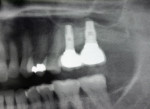Figure 13:  Final panoramic close-up radiographs 3 months after delivery of two bilateral, implant-supported bridge prostheses. A stable alveolar bony foundation can be seen around the implant fixtures, which is adequate to support implant-based restorati