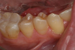 Postoperative occlusal view of the completed Lava Ultimate restorations.