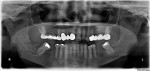 Figure 1 A panoramic radiograph on presentation showing a small portion of the third molar root mainly in the soft tissue above the alveolar bone level.
