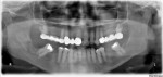 A panoramic radiograph 1 month after extraction demonstrating mottled, mixed, irregular, radiolucent/radiopaque appearance of the posterior mandible around the extracted site, which extended anteriorly to include the adjacent second molar.