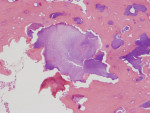 Figure 4 Photomicrograph demonstrating necrotic sclerotic bone of acute osteomyelitis.