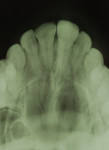 Figure 5 Occlusal radiography.