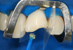 Figure 13 Treatment of the left maxillary central incisor with adhesive.
