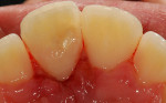 Figure 17 Tooth appearance after 15 days of the treatment (palatal view).