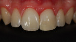 Figure 18 Tooth appearance after the esthetic restorative treatment.