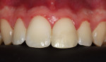 Figure 16 Tooth appearance after 15 days of the treatment (buccal view).