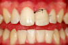 Fig 7. Preoperative panoramic radiograph. Note decay of supporting teeth.