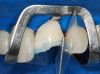Fig 8. Preoperative intraoral photograph. Full-arch restoration was mobile and unesthetic.