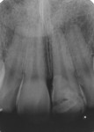 Figure 20 Periapical radiography after 6 months.
