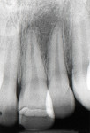 Figure 5 Radiograph of second fracture home repair with superglue.