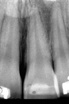 Figure 11 Fourteen-month postoperative radiograph showing no evidence of pathology and orthodontic brackets on adjacent teeth.