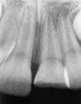 Figure 2 Radiograph of initial fracture before reattachment.